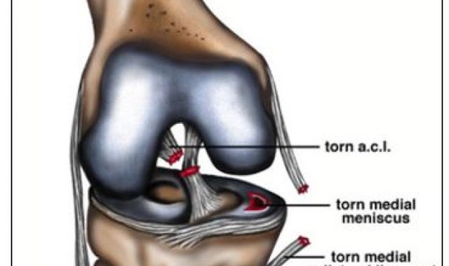 ACL rupture and associated structural injuries of the knee