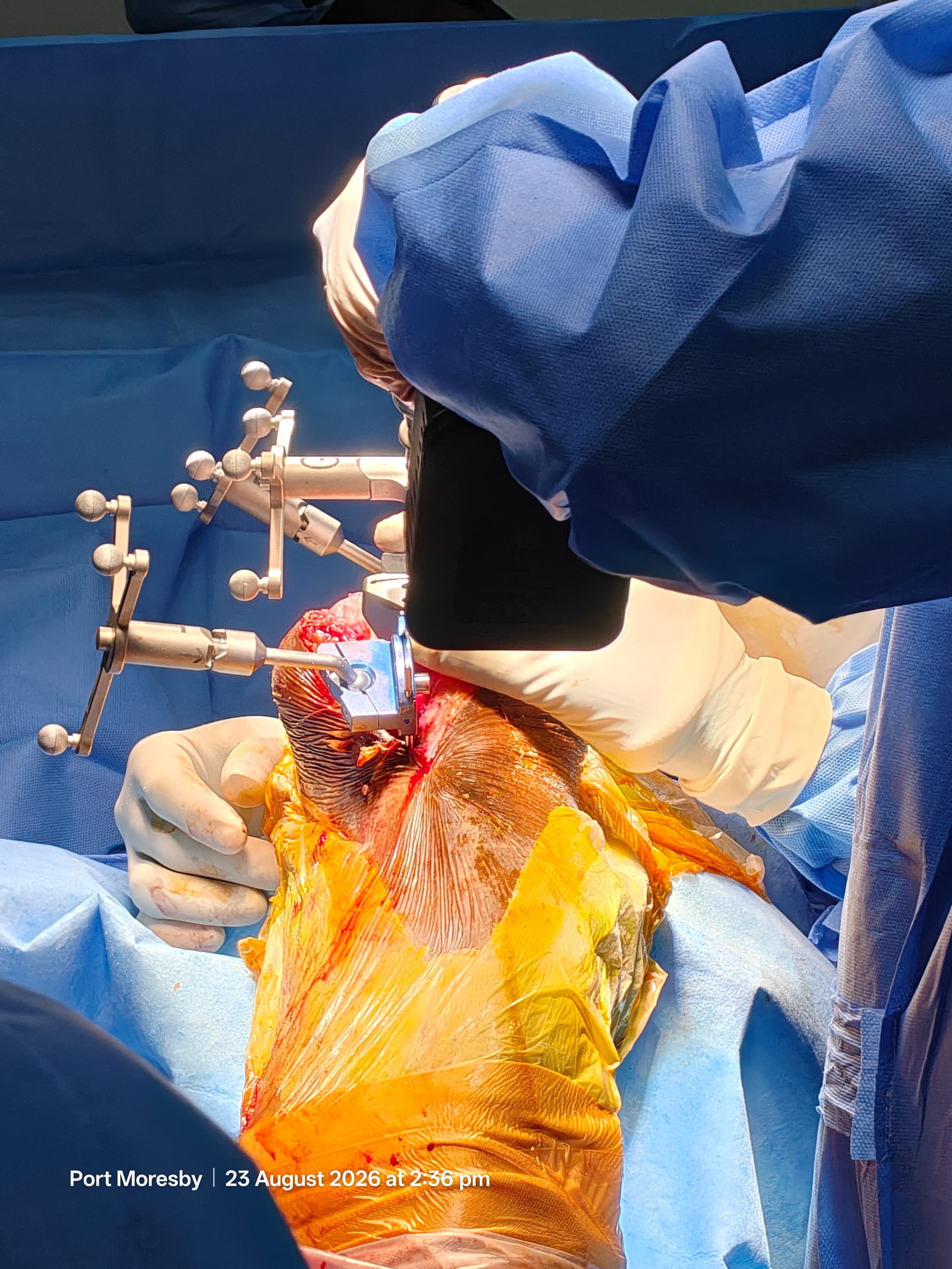 Robotic knee replacment Townsville