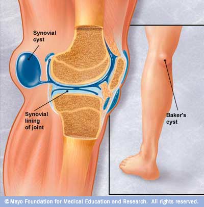 bakers cyst