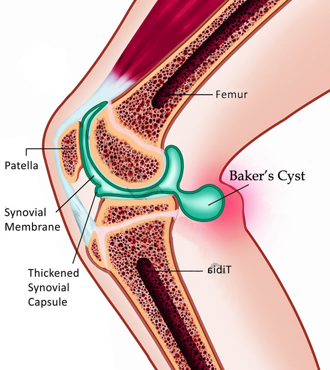 bakers cyst 1