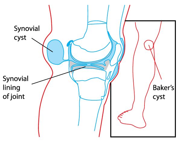 e15f0b21870a95243d451f3c59d2e94f bakers cyst knee injury