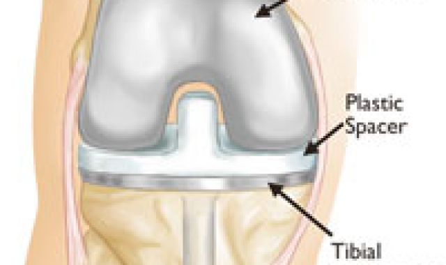 How old is too Young for Hip and knee arthroplasty