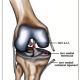 ACL rupture and associated structural injuries of the knee