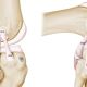 Antero-Lateral Ligament (ALL) Augmentation