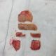 Total Knee Replacement vs Resurfacing