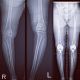 Bilateral (2) Hip and Knee Replacements