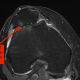 Patella-Femoral Joint Arthritis
