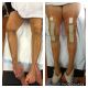 Navigated Medial Epicondylar Slide Osteotomy (TKR)
