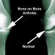 What is Osteoarthritis?