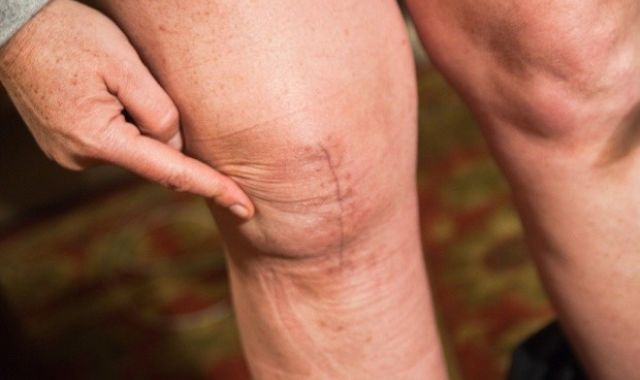 What Can Go Wrong with Knee Replacement????