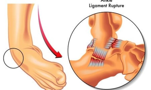 Chronic Ankle Instability