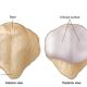 Who is more likely to have anterior patella pain (knee cap)?