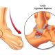 Chronic Ankle Instability