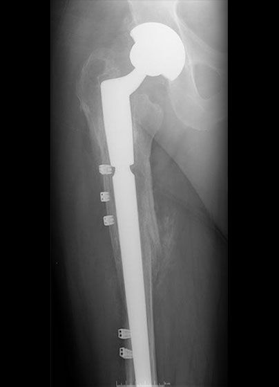Adult Revision Hip And Knee Replacements - Queensland Lower Limb Clinic